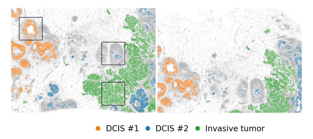 ../../_images/tutorials_human_breast_cancer_xenium_human_breast_cancer_clustering_9_0.png